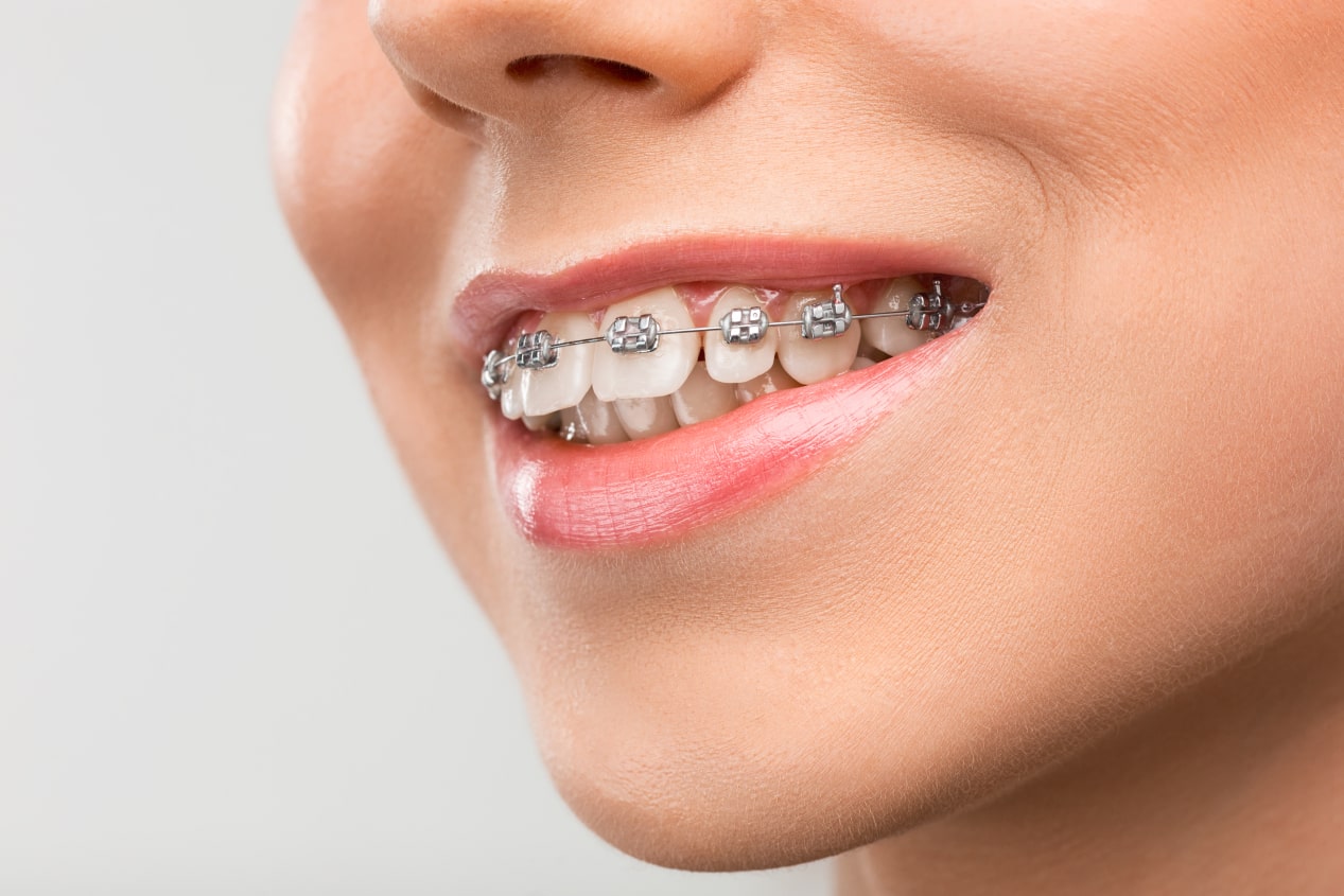 Treatment with dental orthodontics